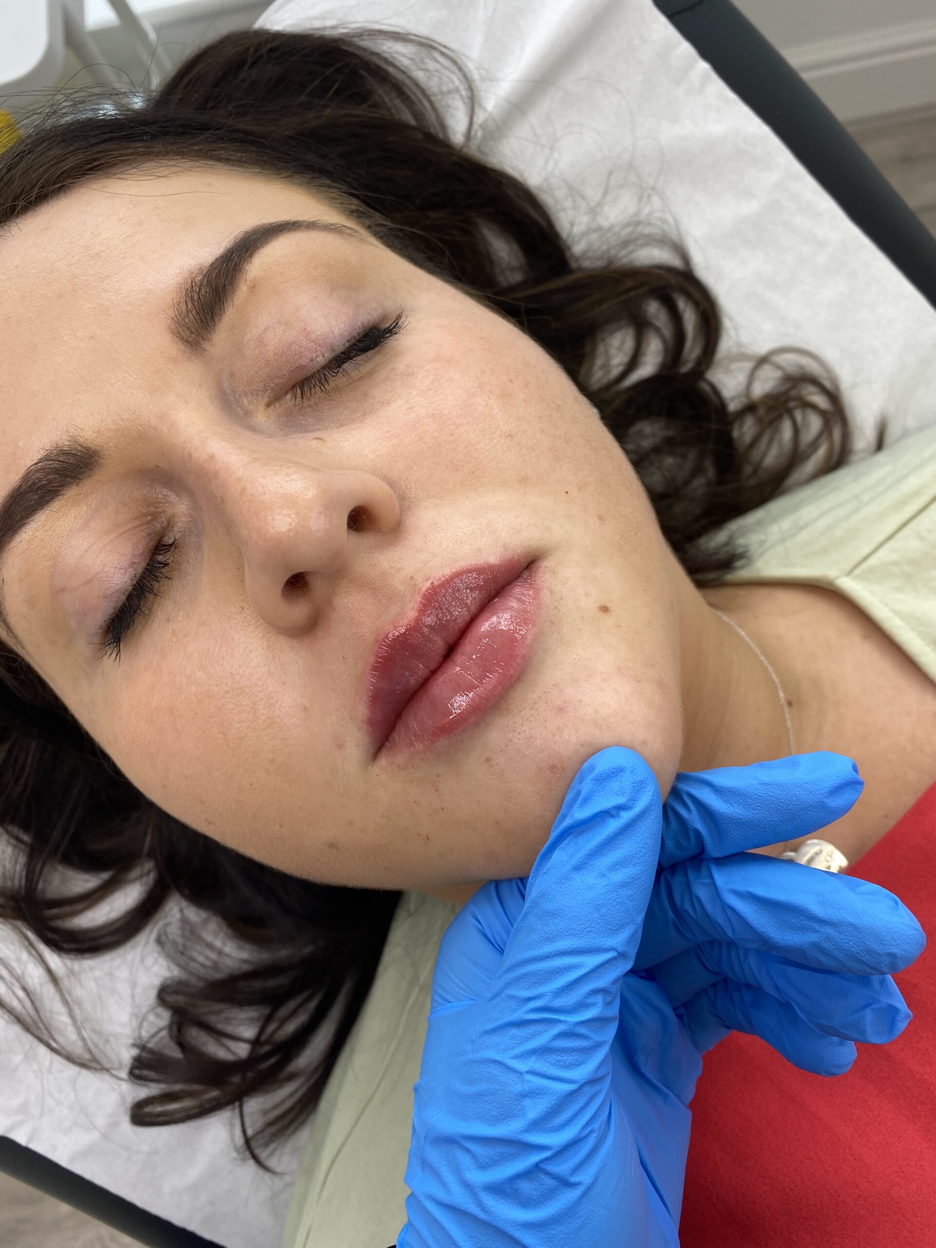 Filler Packages Jaw Cheeks Chin Nasos Smile Lines Lips