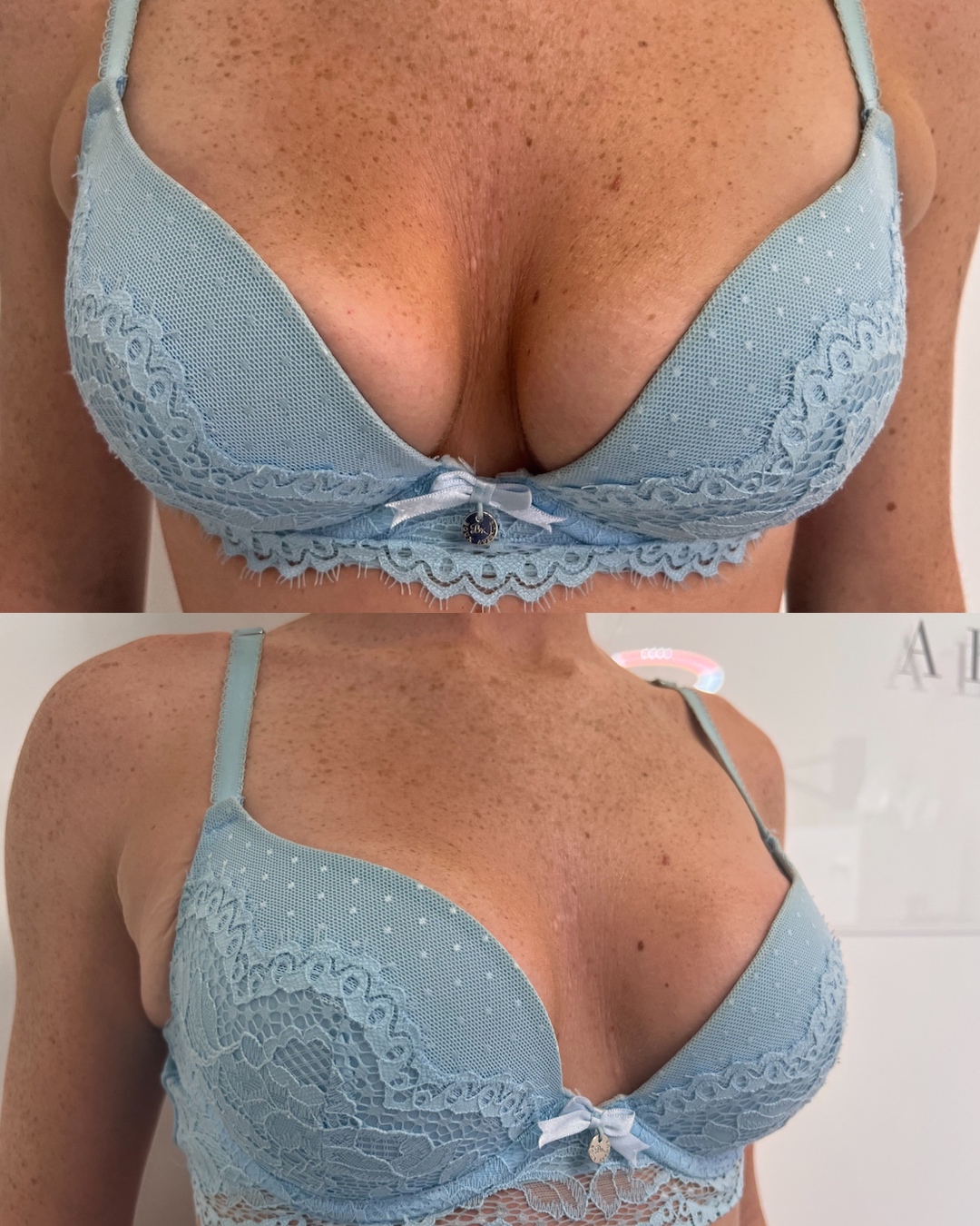 Non-Surgical Breast Enlargement Explored