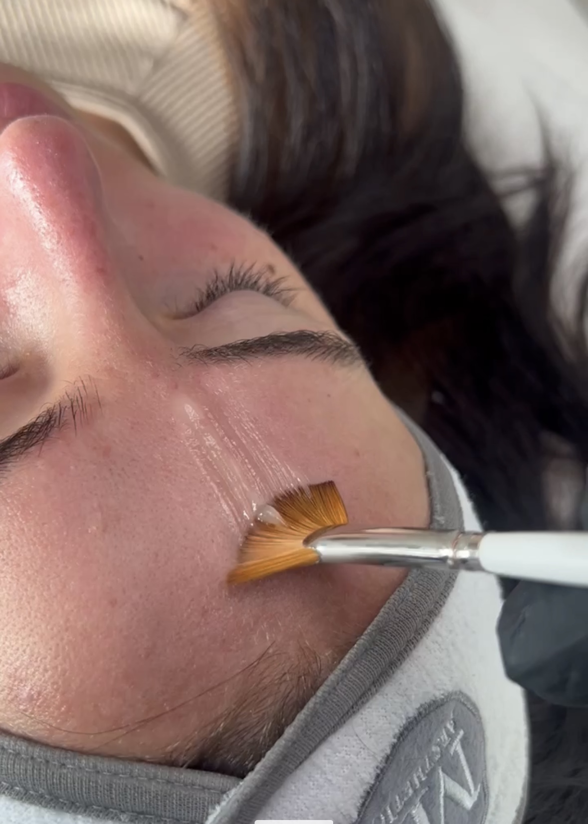 chemical peel