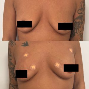breast filler